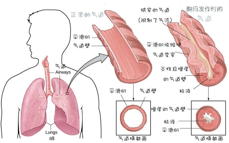 支气管炎怎么治：科学有效方法探寻